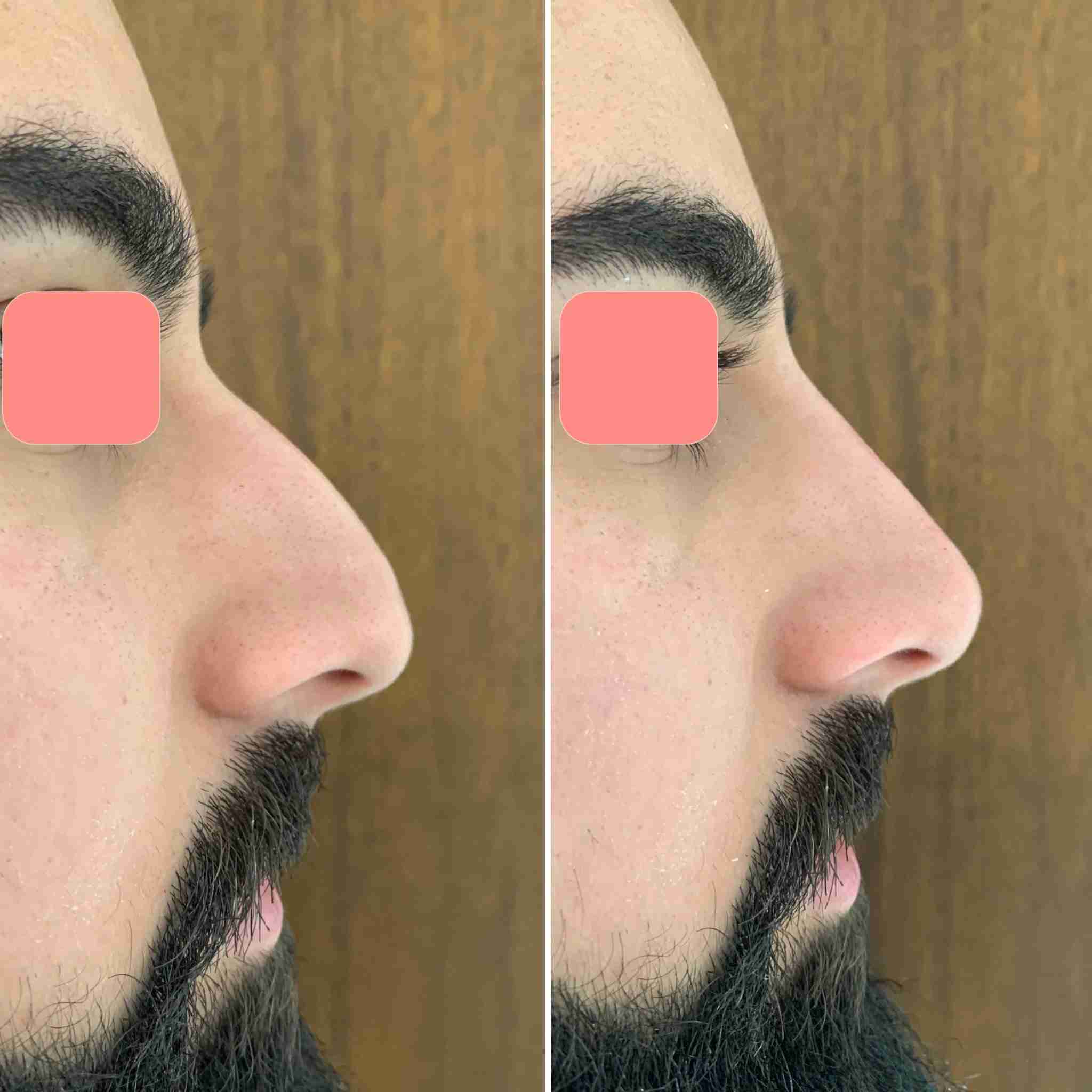 Male non-surgical rhinoplasty