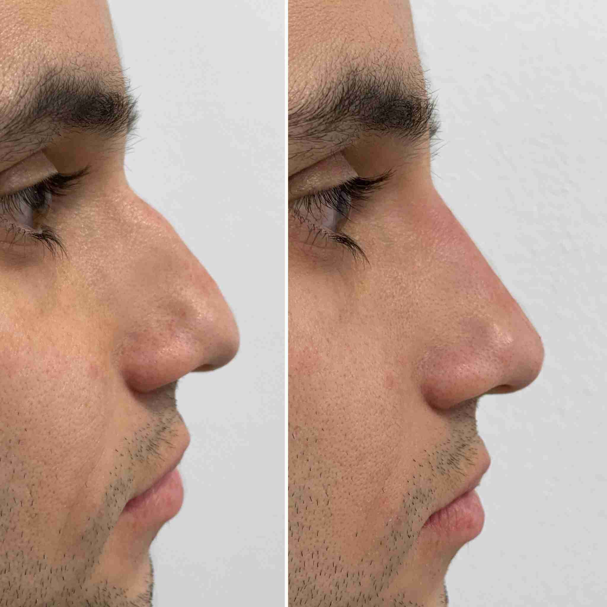 Difference after nose filler