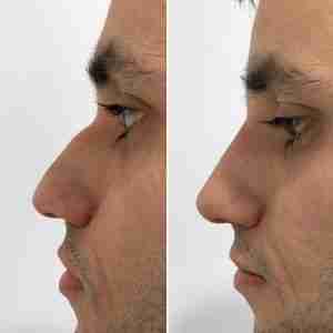 Nose Filler difference