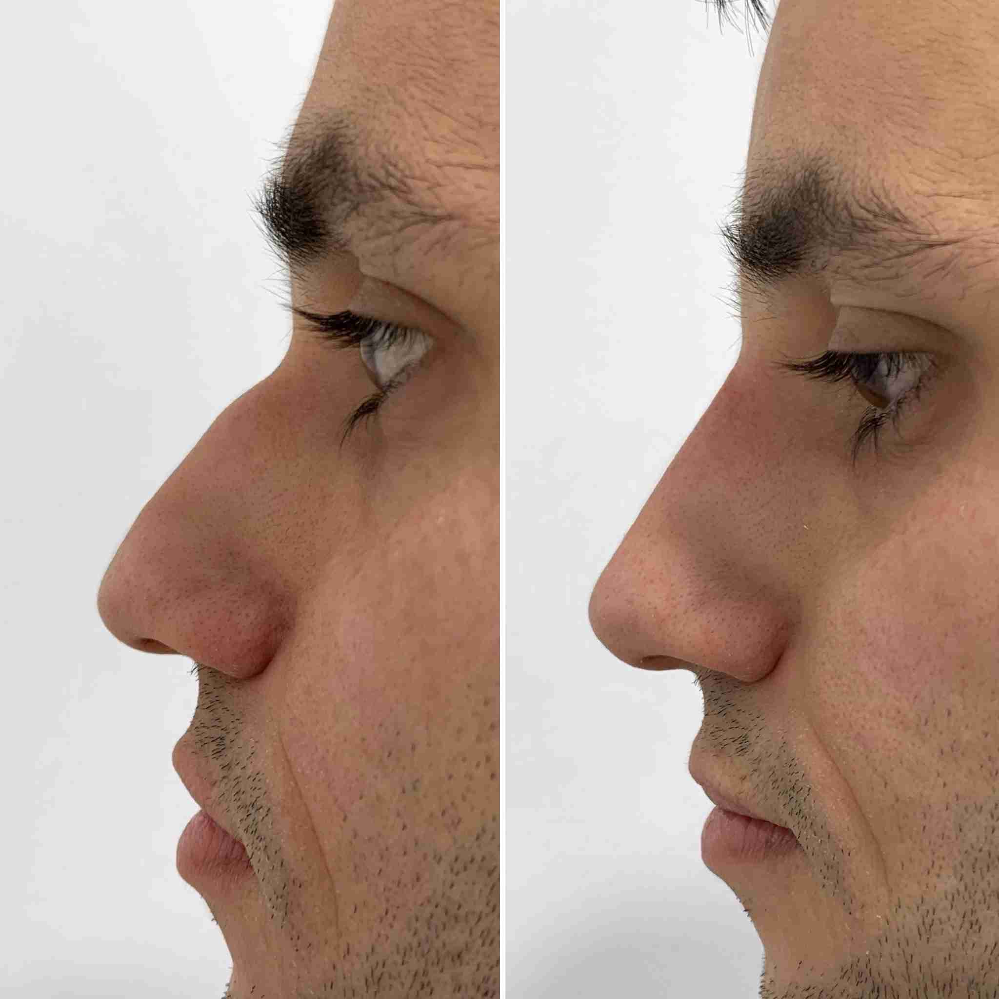 Nose Filler difference