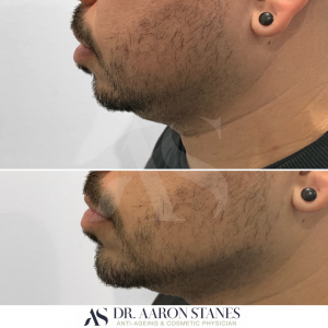 Chin difference after treatment