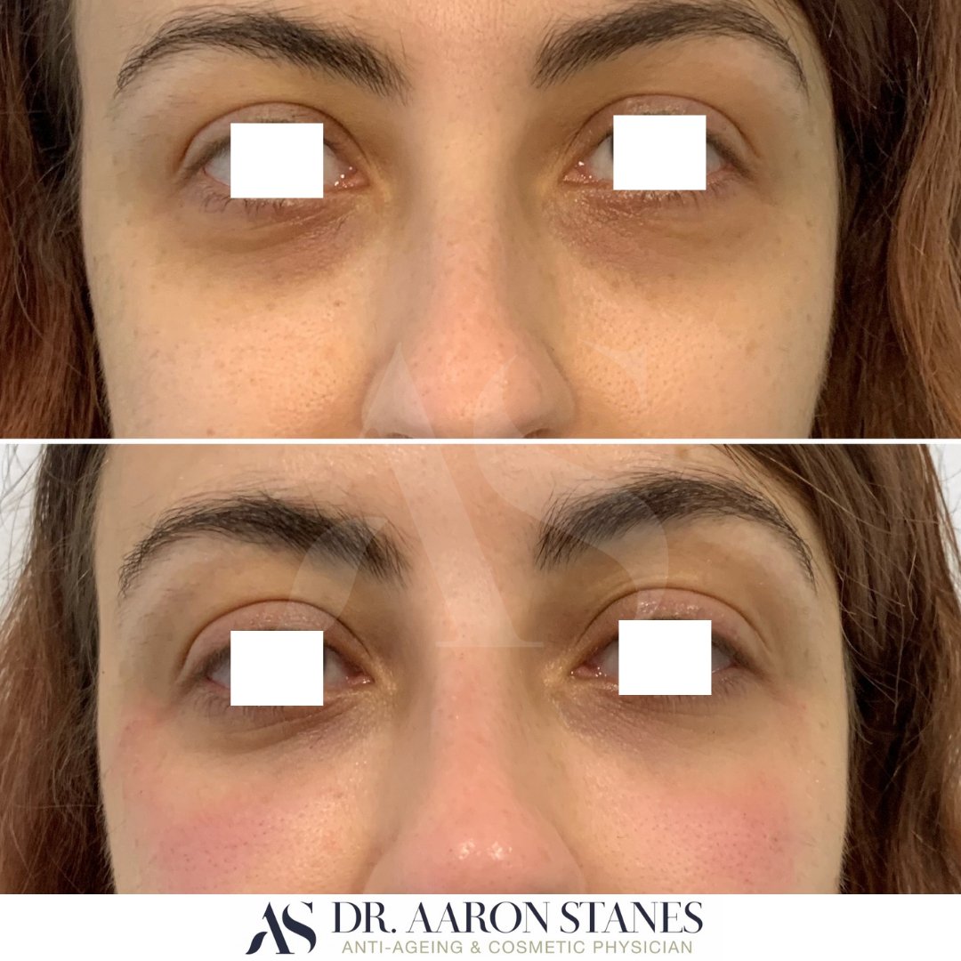 Under eye treatments difference