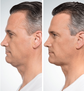 Side Profile-plasty Melbourne to improve your facial definition and balance