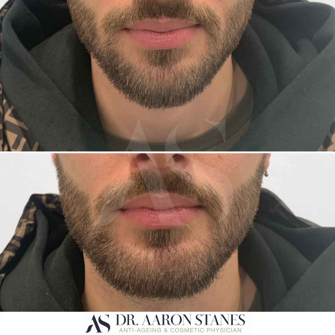 Male chin definition