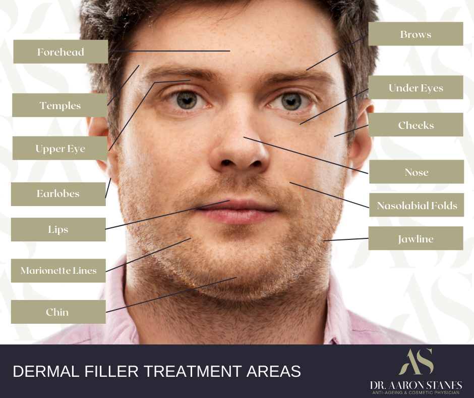 Dermal filler treatments areas